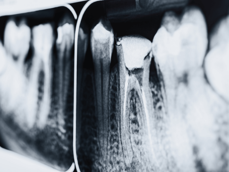 Endodoncia en Sarrià | EVIDENTAL Barcelona Radiografía de un diente tratado mediante endodoncia en EVIDENTAL, clínica dental en Sarrià (Barcelona).