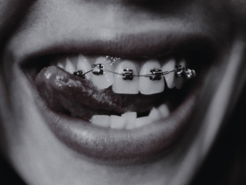 Ortodoncia con Brackets en Sarrià | EVIDENTAL Barcelona Paciente con ortodoncia de brackets metálicos en EVIDENTAL, clínica dental en Sarrià (Barcelona).