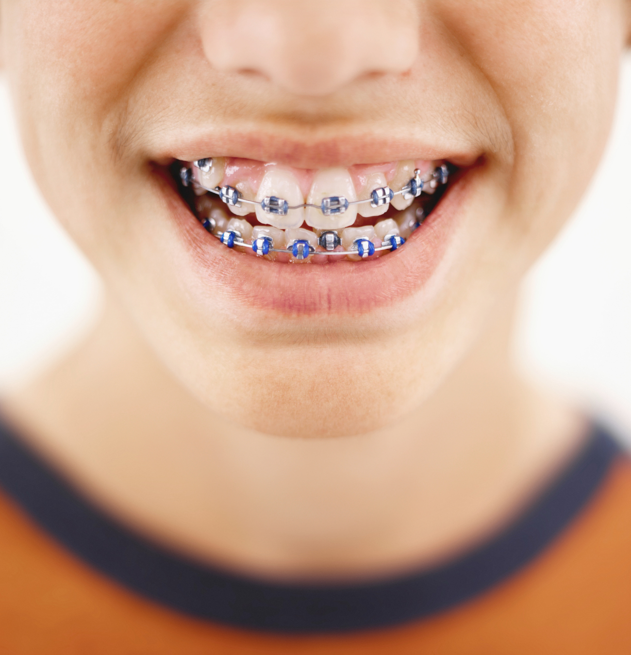 Sonrisa con brackets de ortodoncia
